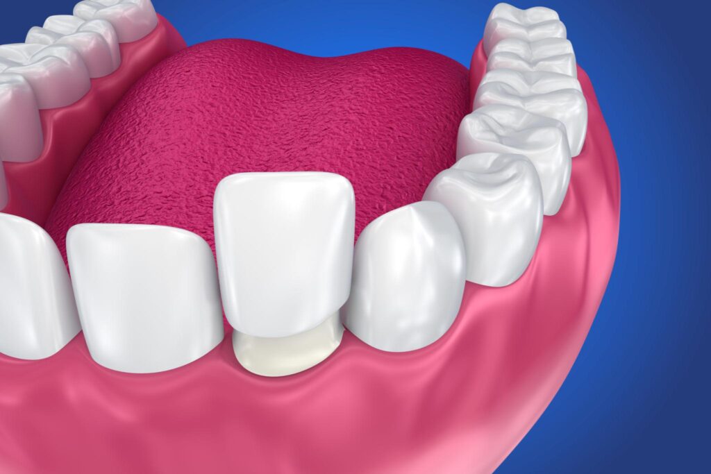 Veneers Near Me